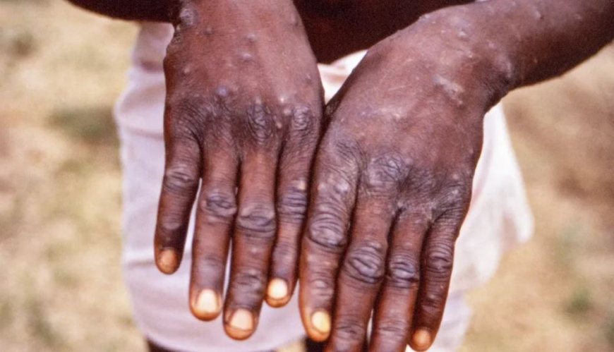 TURASABWA KUBA MASO! RBC Yatangaje ko abarwayi babiri aribo bagaragayeho Ubushita bw’Inkende buzwi nka Monkeypox hano mu Rwanda