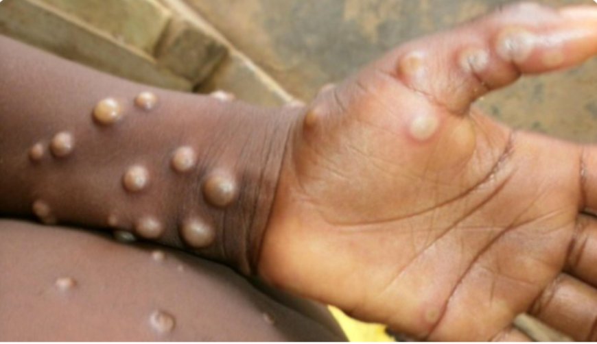 Dore umubare wabandura Mpox bayikura mu mibonano mpuzabitsina